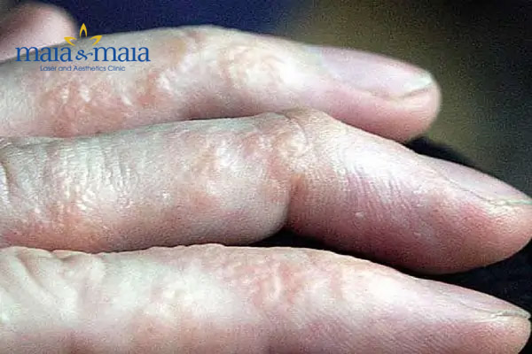 Bệnh tổ đỉa ở ngón tay Bệnh tổ đỉa ở ngón tay