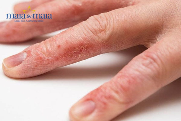 Bệnh tổ đỉa ở tay Bệnh tổ đỉa ở tay