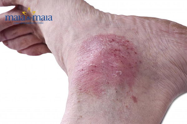 Bệnh vảy nến ở chân Bệnh vảy nến ở chân