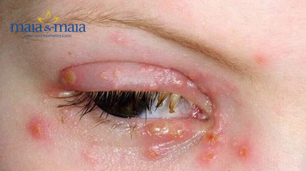 Zona ở mắt rất nguy hiểm Zona ở mắt rất nguy hiểm