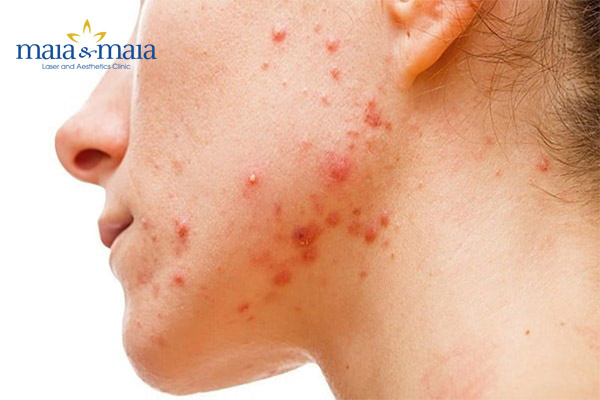 Điều trị mụn trứng cá Điều trị mụn trứng cá