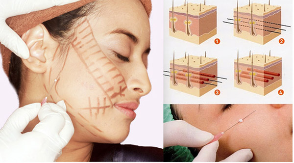Kéo căng trẻ hóa da bằng chỉ sinh học Kéo căng trẻ hóa da bằng chỉ sinh học
