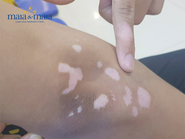 Sử dụng kem bôi trị bạch biến Sử dụng kem bôi trị bạch biến