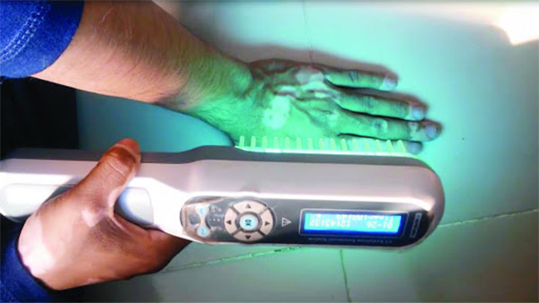 Phương pháp quang hóa trị liệu UVA, UVB Phương pháp quang hóa trị liệu UVA, UVB