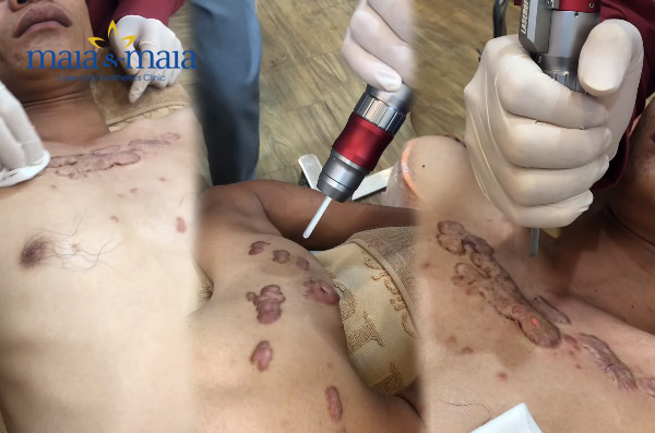 Công nghệ điều trị sẹo lồi Công nghệ điều trị sẹo lồi