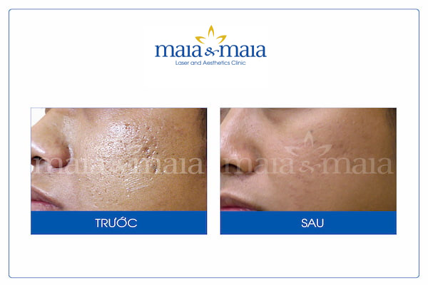 Hình ảnh: Trước - Sau khi được hỗ trợ điều trị sẹo bằng Laser Hình ảnh: Trước - Sau khi được hỗ trợ điều trị sẹo bằng Laser