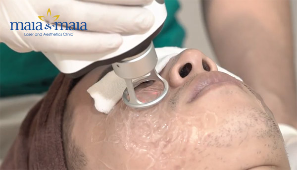 Công nghệ điều trị sẹo lõm Công nghệ điều trị sẹo lõm
