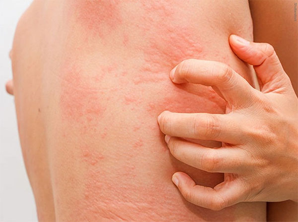 Nổi mề đay sau sinh có thể gây biến chứng Nổi mề đay sau sinh có thể gây biến chứng