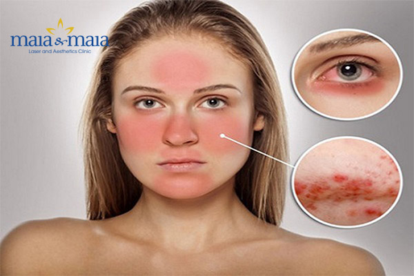 Da đỏ rát, nhạy cảm do nắng Da đỏ rát, nhạy cảm do nắng