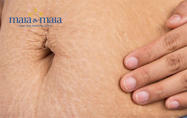 Điều trị rạn da quá muộn Điều trị rạn da quá muộn