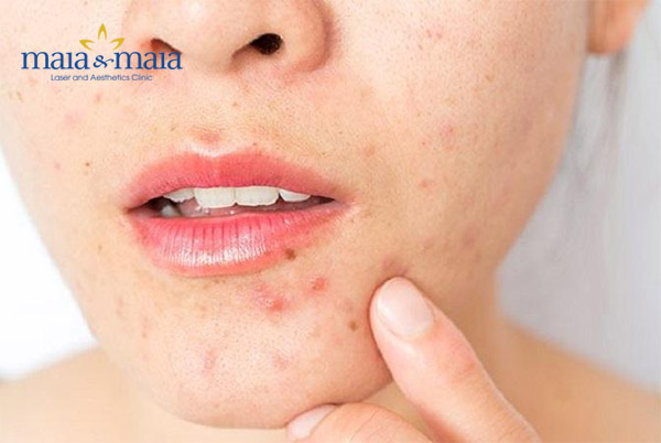 Da bị mụn do đeo khẩu trang sai cách Da bị mụn do đeo khẩu trang sai cách