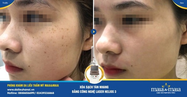 Hiệu quả trước và sau khi hỗ trợ điều trị nám Hiệu quả trước và sau khi hỗ trợ điều trị nám