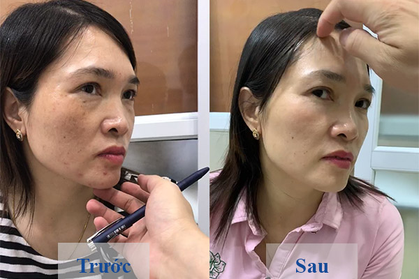 Hiệu quả trước và sau khi hỗ trợ điều trị nám Hiệu quả trước và sau khi hỗ trợ điều trị nám