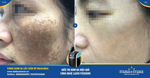 Hiệu quả trước và sau khi hỗ trợ điều trị nám Hiệu quả trước và sau khi hỗ trợ điều trị nám