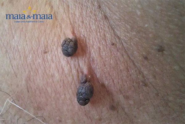 U mềm treo trên da U mềm treo trên da