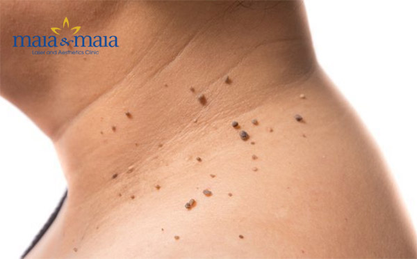 U mềm treo trên cổ U mềm treo trên cổ