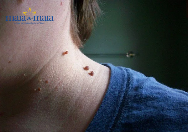 U mềm treo gây ra nhiều biến chứng U mềm treo gây ra nhiều biến chứng