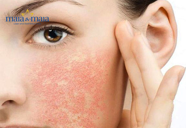 Làn da dị ứng với mỹ phẩm Làn da dị ứng với mỹ phẩm