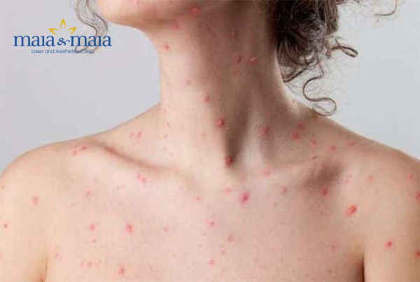 Bệnh ngoài da thường gặp Bệnh ngoài da thường gặp