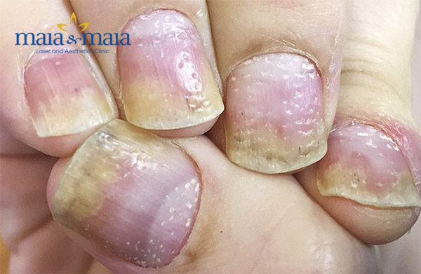 Vảy nến gây tổn thương móng tay Vảy nến gây tổn thương móng tay
