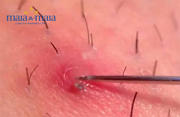 Viêm nang lông có thể trị và phòng ngừa được Viêm nang lông có thể trị và phòng ngừa được