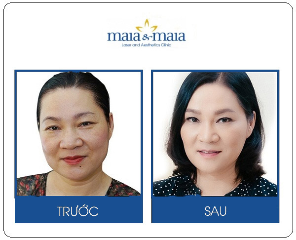 Hình ảnh trước và sau khi xóa nhăn mắt của MC - BTV Kim Ngân Hình ảnh trước và sau khi xóa nhăn mắt của MC - BTV Kim Ngân