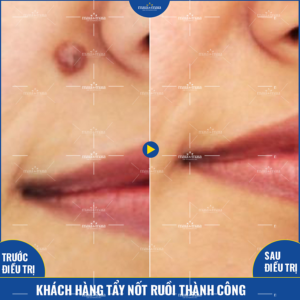 Kết quả hỗ trợ điều trị nốt ruồi tại phòng khám Kết quả hỗ trợ điều trị nốt ruồi tại phòng khám