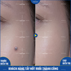 Kết quả hỗ trợ điều trị nốt ruồi tại phòng khám Kết quả hỗ trợ điều trị nốt ruồi tại phòng khám