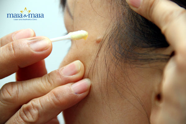 Nguy hiểm tiềm ẩn khi tẩy nốt ruồi tại nhà Nguy hiểm tiềm ẩn khi tẩy nốt ruồi tại nhà