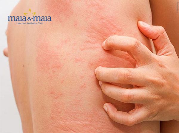 Mề đay cholinergic gây ảnh hưởng tới chất lượng cuộc sống Mề đay cholinergic gây ảnh hưởng tới chất lượng cuộc sống