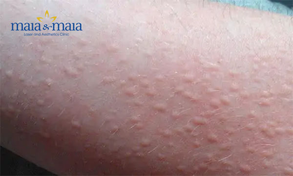 Triệu chứng của mề đay cholinergic Triệu chứng của mề đay cholinergic