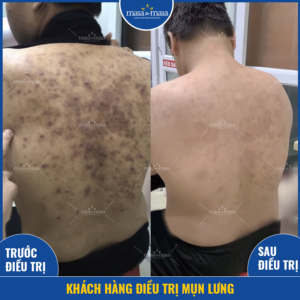 Hiệu quả hỗ trợ điều trị mụn lưng tại phòng khám Hiệu quả hỗ trợ điều trị mụn lưng tại phòng khám