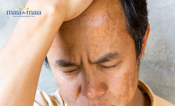 Nguyên nhân gây nám da mặt ở nam giới Nguyên nhân gây nám da mặt ở nam giới