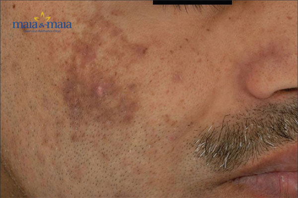 Chữa nám da ở nam bằng công nghệ Laser Helios 3 Chữa nám da ở nam bằng công nghệ Laser Helios 3