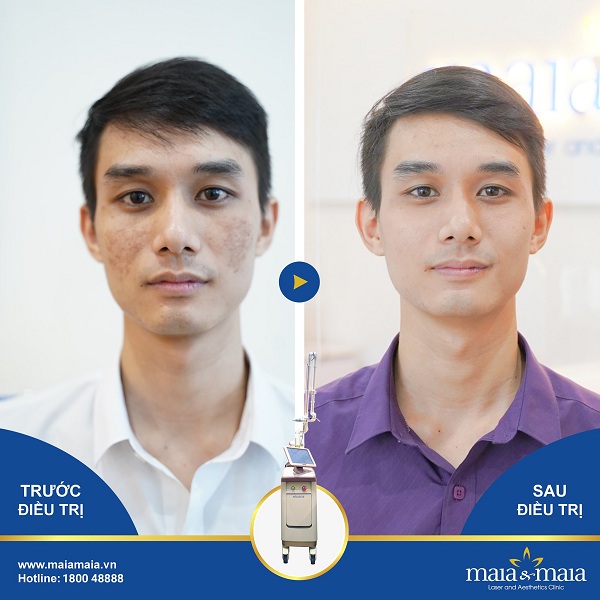 Khách hàng điều trị nám da thành công Khách hàng điều trị nám da thành công