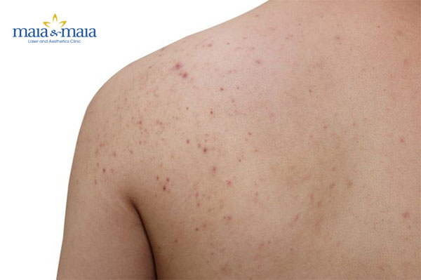 Không làm sạch các sản phẩm tắm gội sẽ gây mụn sau lưng Không làm sạch các sản phẩm tắm gội sẽ gây mụn sau lưng
