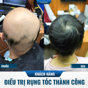 Hình ảnh khách hàng điều trị rụng tóc thành công Hình ảnh khách hàng điều trị rụng tóc thành công