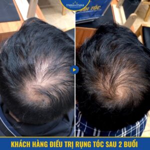 Hình ảnh khách hàng điều trị rụng tóc thành công Hình ảnh khách hàng điều trị rụng tóc thành công