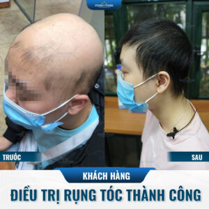 Hình ảnh khách hàng điều trị rụng tóc thành công Hình ảnh khách hàng điều trị rụng tóc thành công