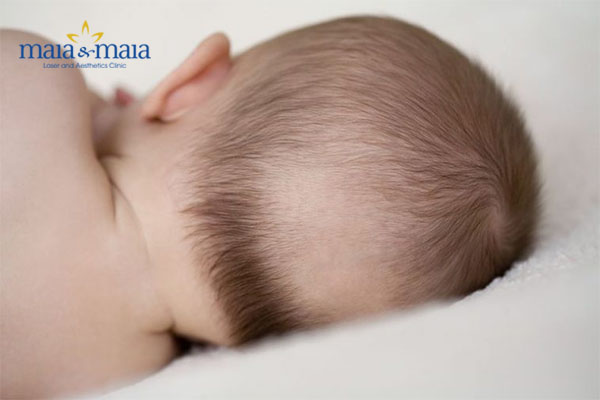 Rụng tóc hình vành khăn một phần do tư thế nằm của trẻ Rụng tóc hình vành khăn một phần do tư thế nằm của trẻ