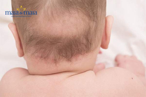 Rụng tóc vành khăn Rụng tóc vành khăn