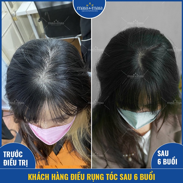Hình ảnh khách hàng điều trị rụng tóc thành công
