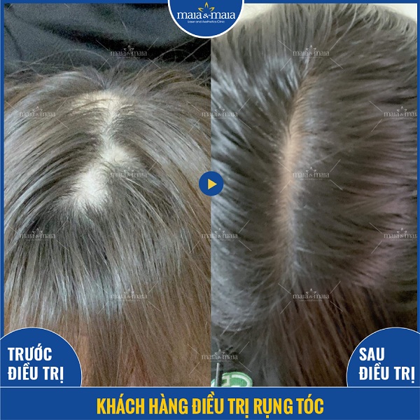Hình ảnh khách hàng điều trị rụng tóc thành công