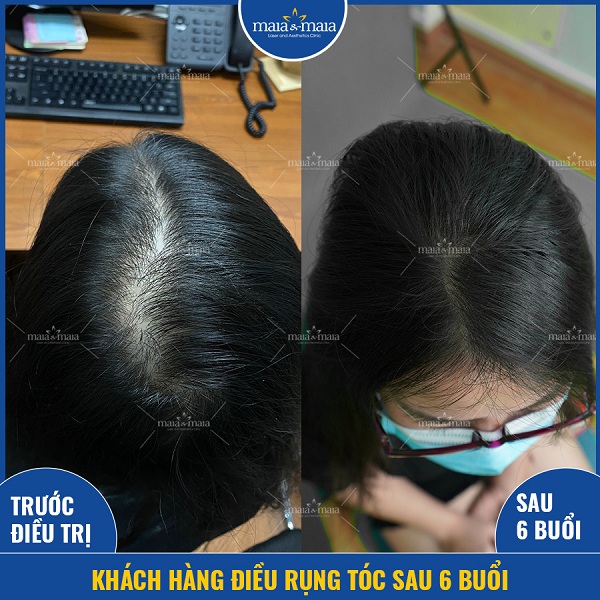 Hình ảnh khách hàng điều trị rụng tóc thành công