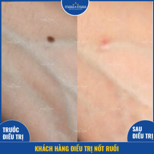Kết quả hỗ trợ điều trị nốt ruồi tại phòng khám Kết quả hỗ trợ điều trị nốt ruồi tại phòng khám