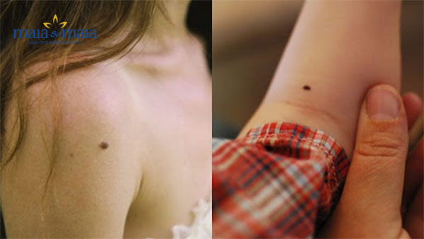 Tẩy nốt ruồi Tẩy nốt ruồi