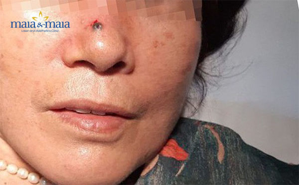 Hiểm họa tiềm ẩn khi tẩy nốt ruồi sai cách Hiểm họa tiềm ẩn khi tẩy nốt ruồi sai cách