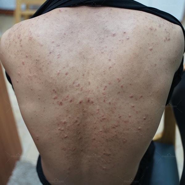 Mụn trứng cá ở lưng gây nhiều vết thâm, sẹo rỗ Mụn trứng cá ở lưng gây nhiều vết thâm, sẹo rỗ