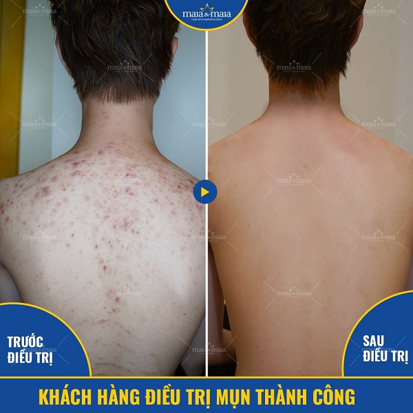 Hiệu quả hỗ trợ điều trị mụn lưng tại phòng khám Hiệu quả hỗ trợ điều trị mụn lưng tại phòng khám