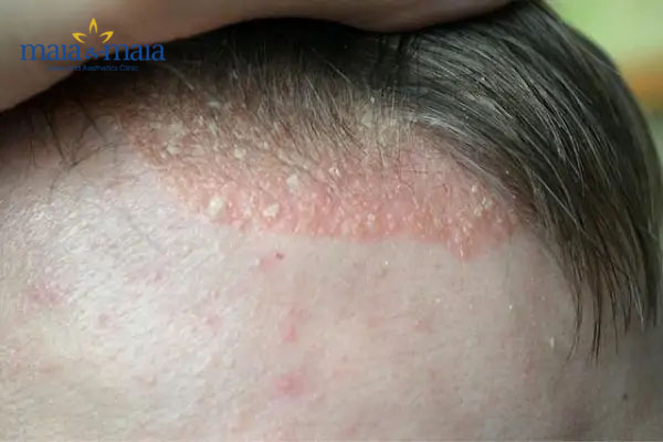 Vảy nến da đầu Vảy nến da đầu